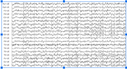 EEG - neuroofeedback in NYC - types of neurofeedback - neurofeedback for depression - 10018 - 10010 - 10003 EEG readout. Neurofeedback is a noninvasive treatment to address mental health concerns such as depression and anxiety. Learn more abput neurofeedback in NYC here.