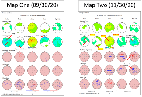 Brain maps from neurofeedback sessions. Neurofeedback can help retrain your brain to create a more stable nervous system state. Neurofeedback in NYC is a cutting edge treatment for ADHD. learn more here.